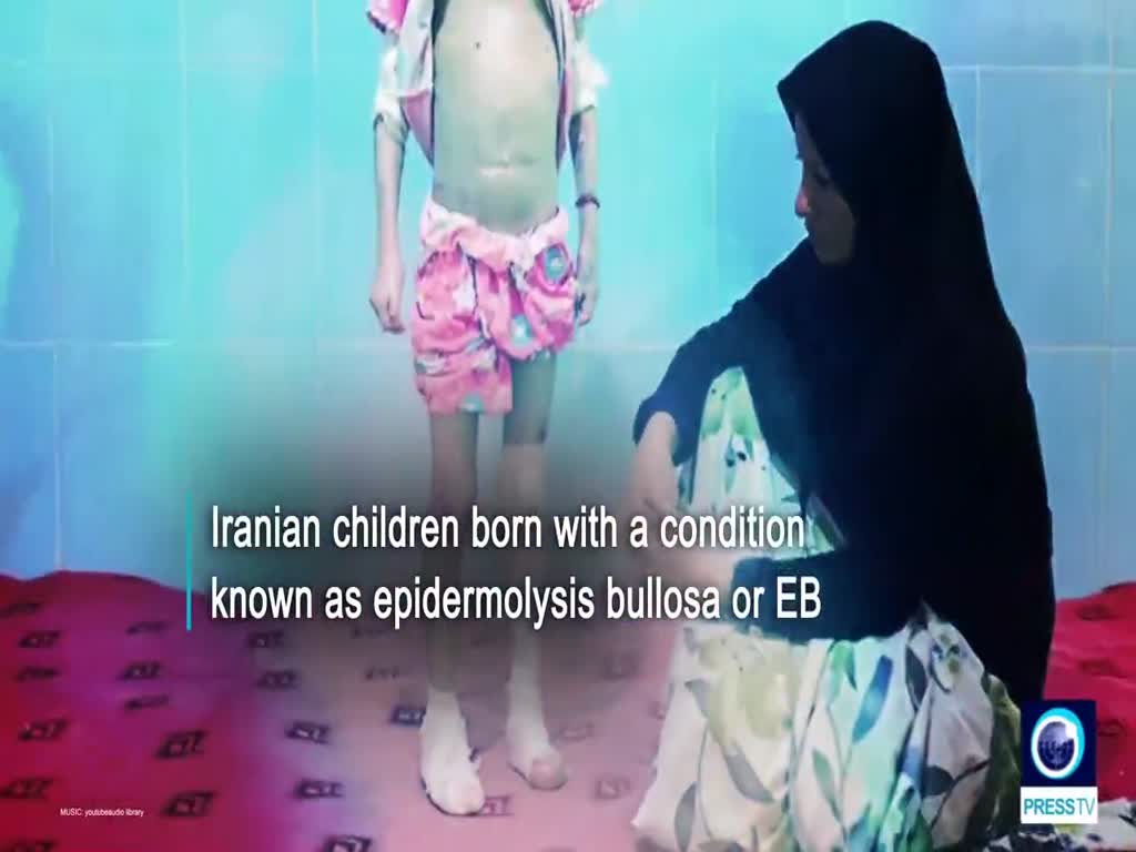[30 May 2019] Iranian children feel the brunt of US sanctions with their skin. - English