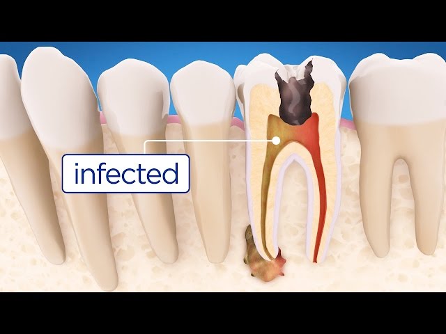Root Canal Treatment Step by Step - English