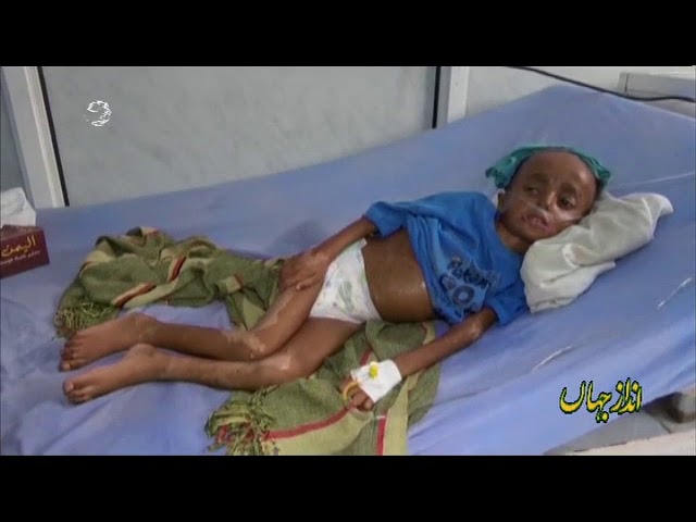 [13Aug2018]  یمنی بچوں پر سعودی اتحاد کی بمباری- Urdu