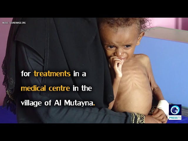 [3 December 2018]  Yemen crisis: 85,000 children \'dead from malnutrition\' - English